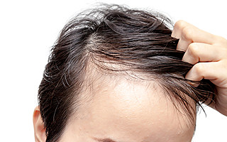 雍禾植發沖刺港股：廣告年開支5億元，脫發焦慮將撐起多大市值?