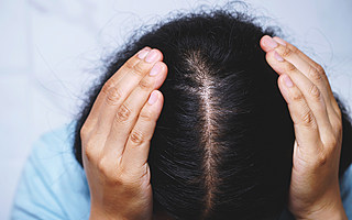 当代青年之烦恼：头发20块一根，秃得起，种不起