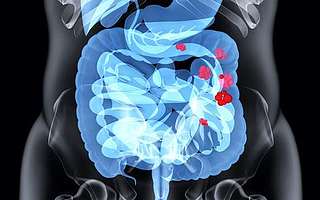 粪菌移植的背后，肠道菌那些你不知道的事儿